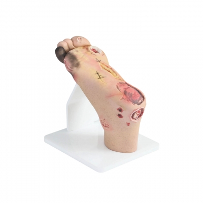重症糖尿病足模型